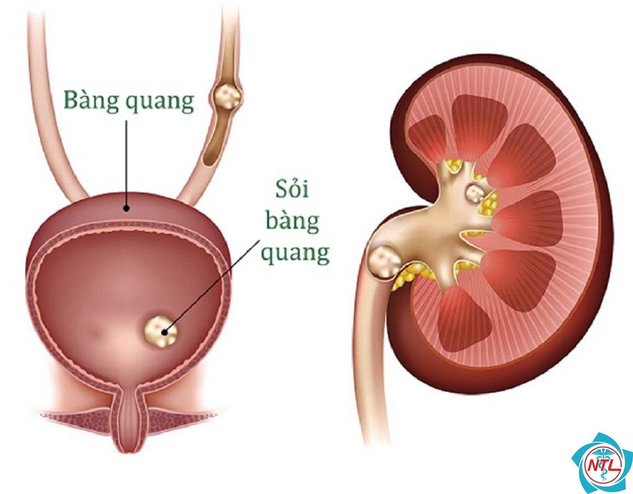 sỏi bàng quang - Image 1