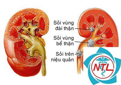 sỏi đường tiết niệu - Image 3