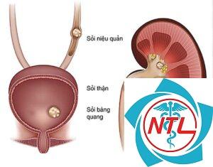 sỏi đường tiết niệu