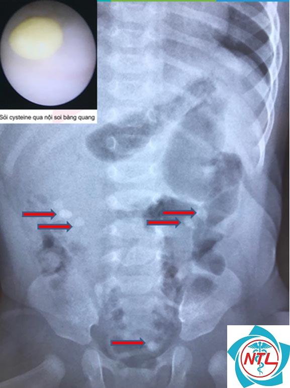 sỏi đường tiết niệu ở trẻ em - Image 3