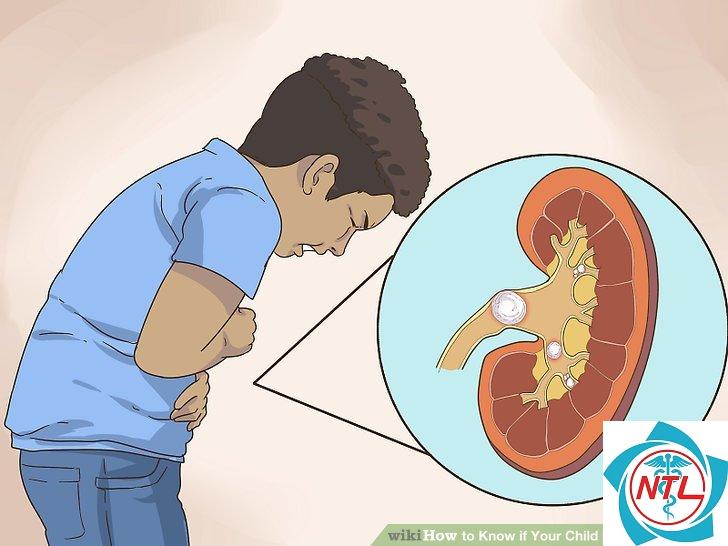 sỏi đường tiết niệu ở trẻ em - Image 4