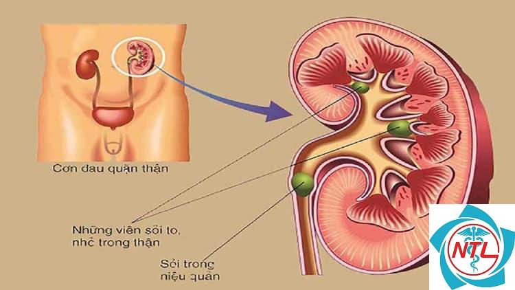 sỏi đường tiết niệu ở trẻ em - Image 5