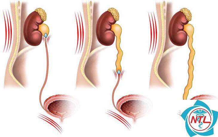 sỏi niệu quản - Image 2