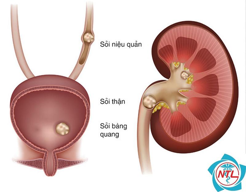 sỏi niệu quản - Image 4