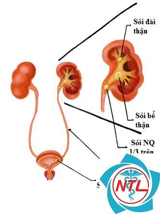sỏi niệu quản - Image 5