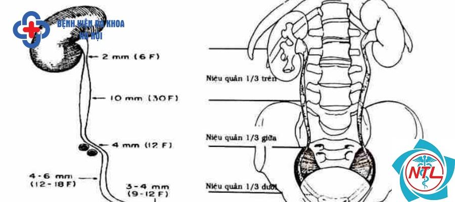 sỏi niệu quản đoạn dưới - Image 2