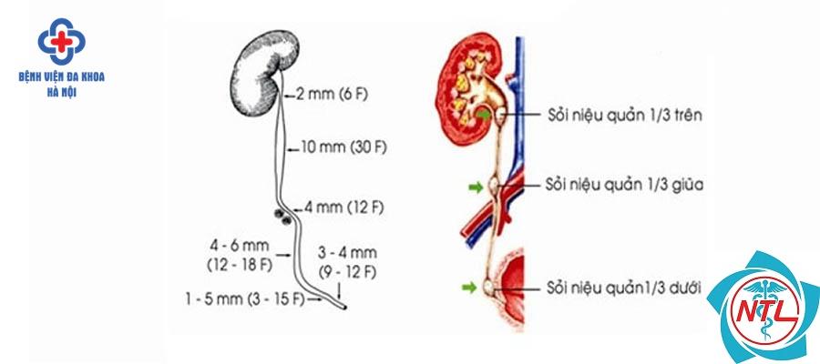 sỏi niệu quản đoạn dưới - Image 4