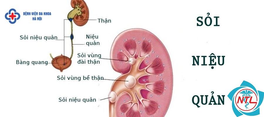 sỏi niệu quản đoạn giữa - Image 4