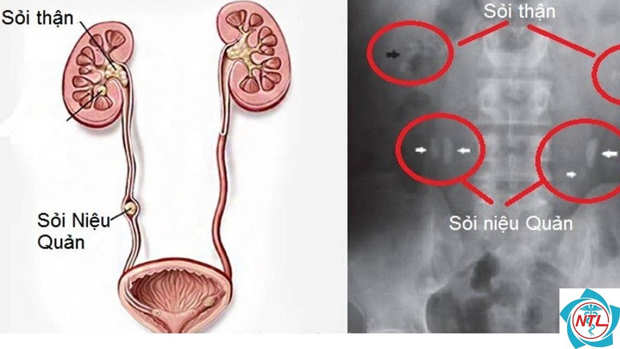 sỏi niệu quản đoạn giữa - Image 5