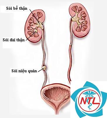 sỏi niệu quản gây tắc nghẽn - Image 4