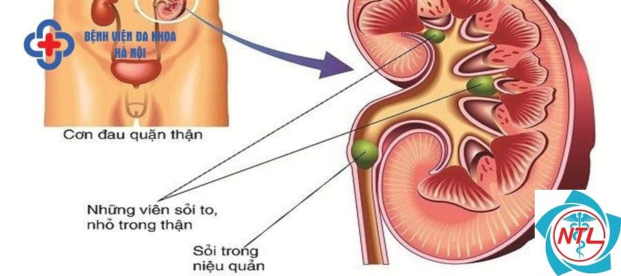 sỏi niệu quản gây tắc nghẽn