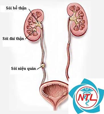 sỏi niệu quản - Image 1