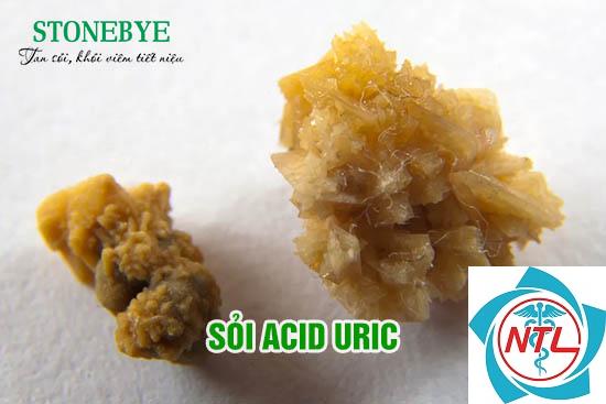 sỏi thận axit uric