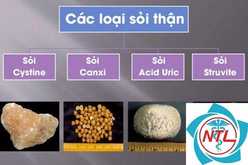 sỏi thận canxi
