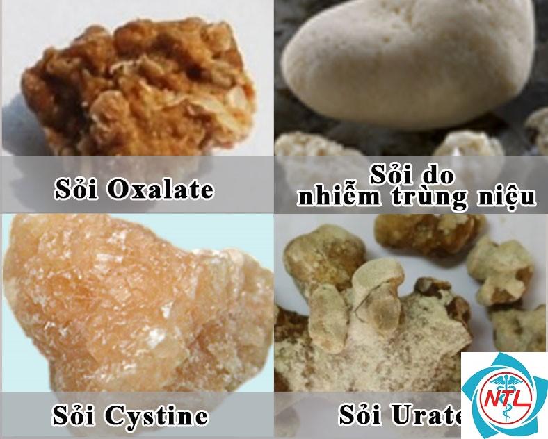 sỏi thận cystine - Image 2