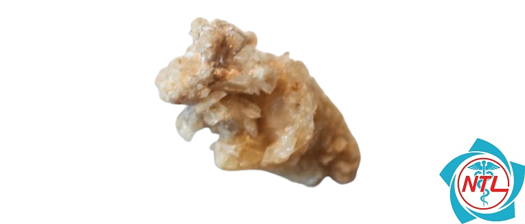 sỏi thận cystine - Image 3