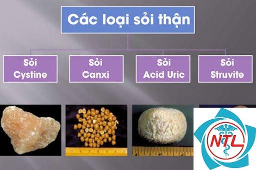 sỏi thận cystine - Image 4