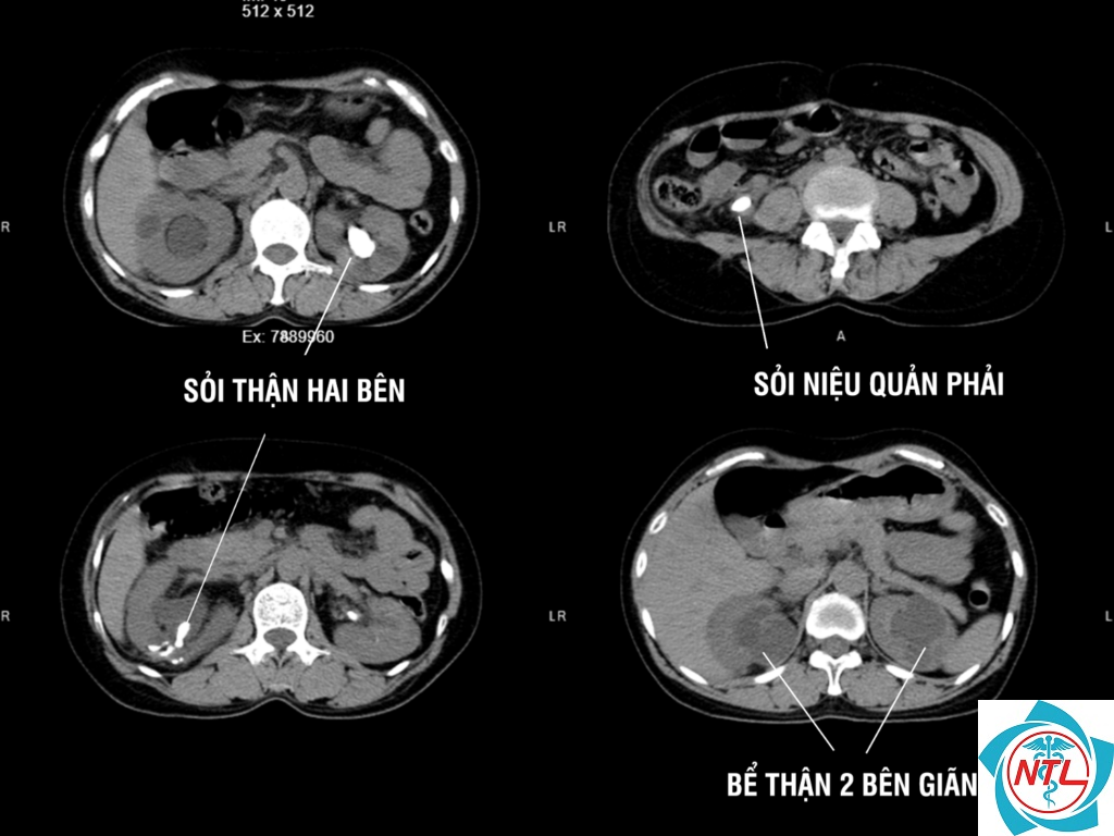 sỏi thận hai bên