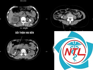 sỏi thận hai bên