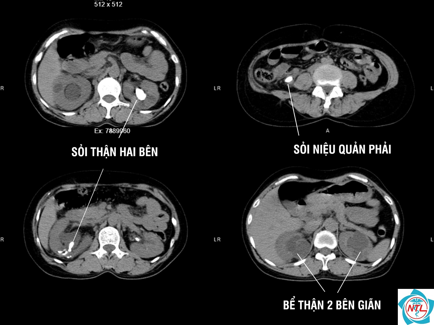 sỏi thận hai bên - Image 1