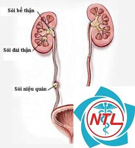 sỏi thận niệu quản