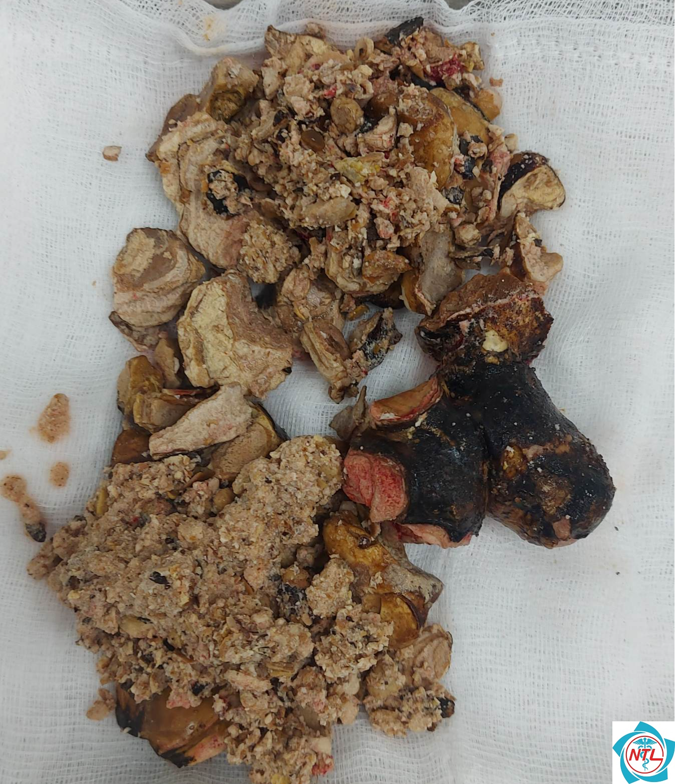 sỏi thận ở người cao tuổi - Image 5