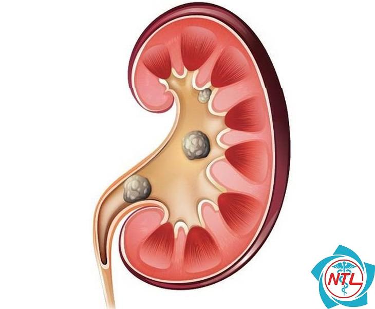 sỏi thận ở phụ nữ mang thai - Image 2