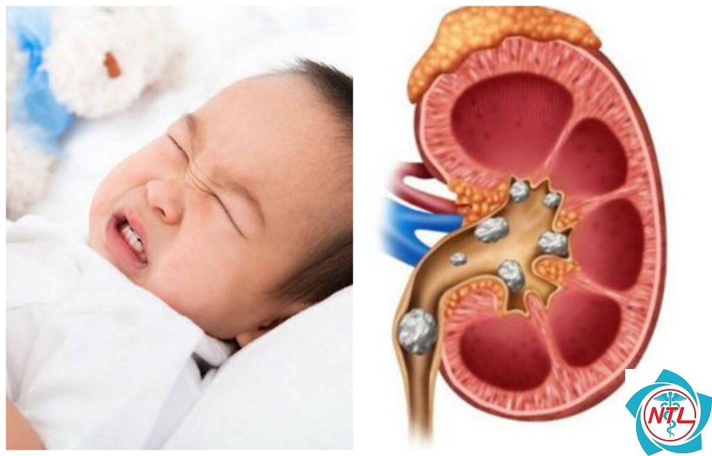 sỏi thận ở trẻ em