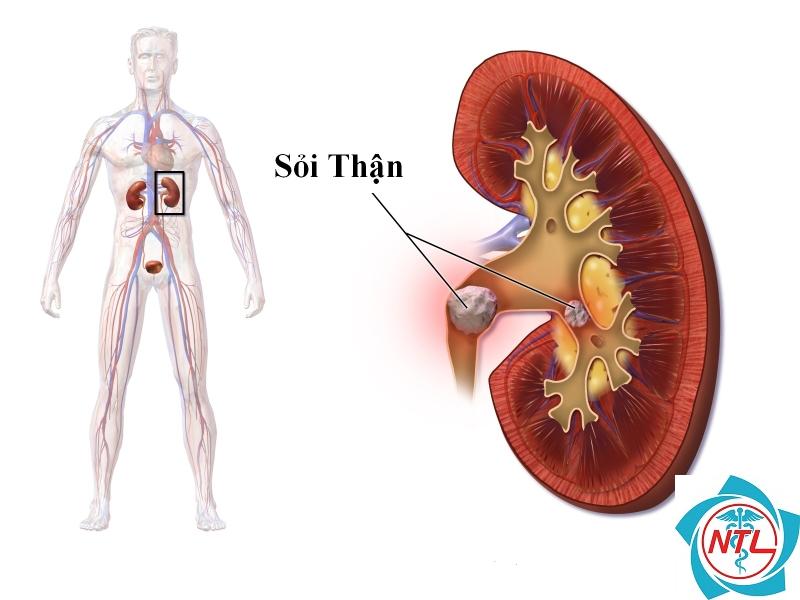 sỏi thận ở trẻ em - Image 5