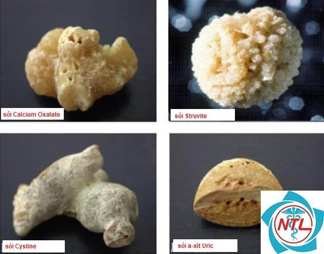 sỏi thận struvite - Image 3