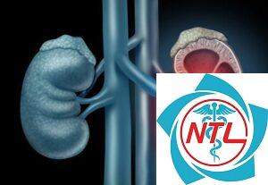 sỏi thận tái phát