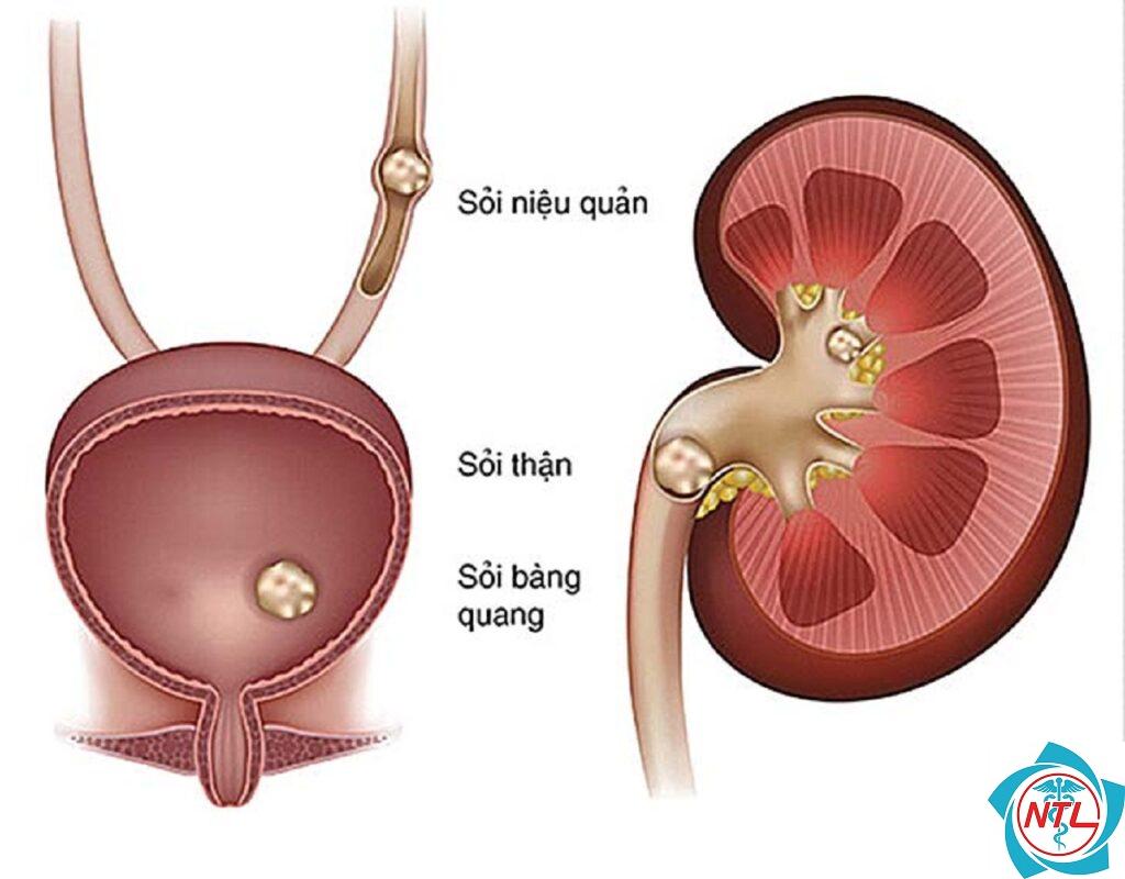 sỏi tiết niệu