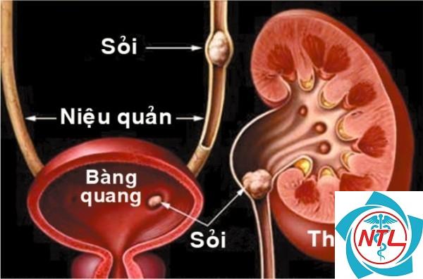 sỏi tiết niệu - Image 5