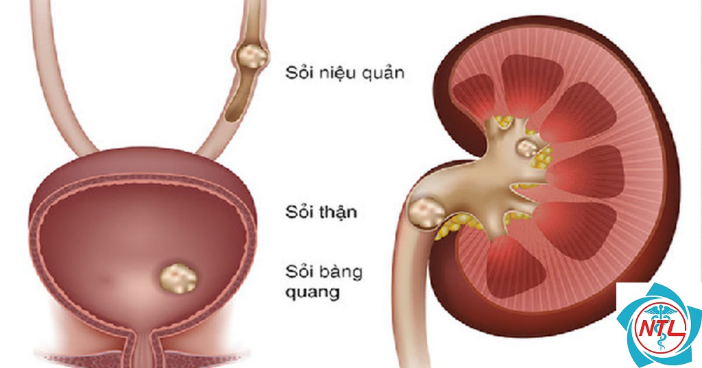 sỏi tiết niệu ở người cao tuổi