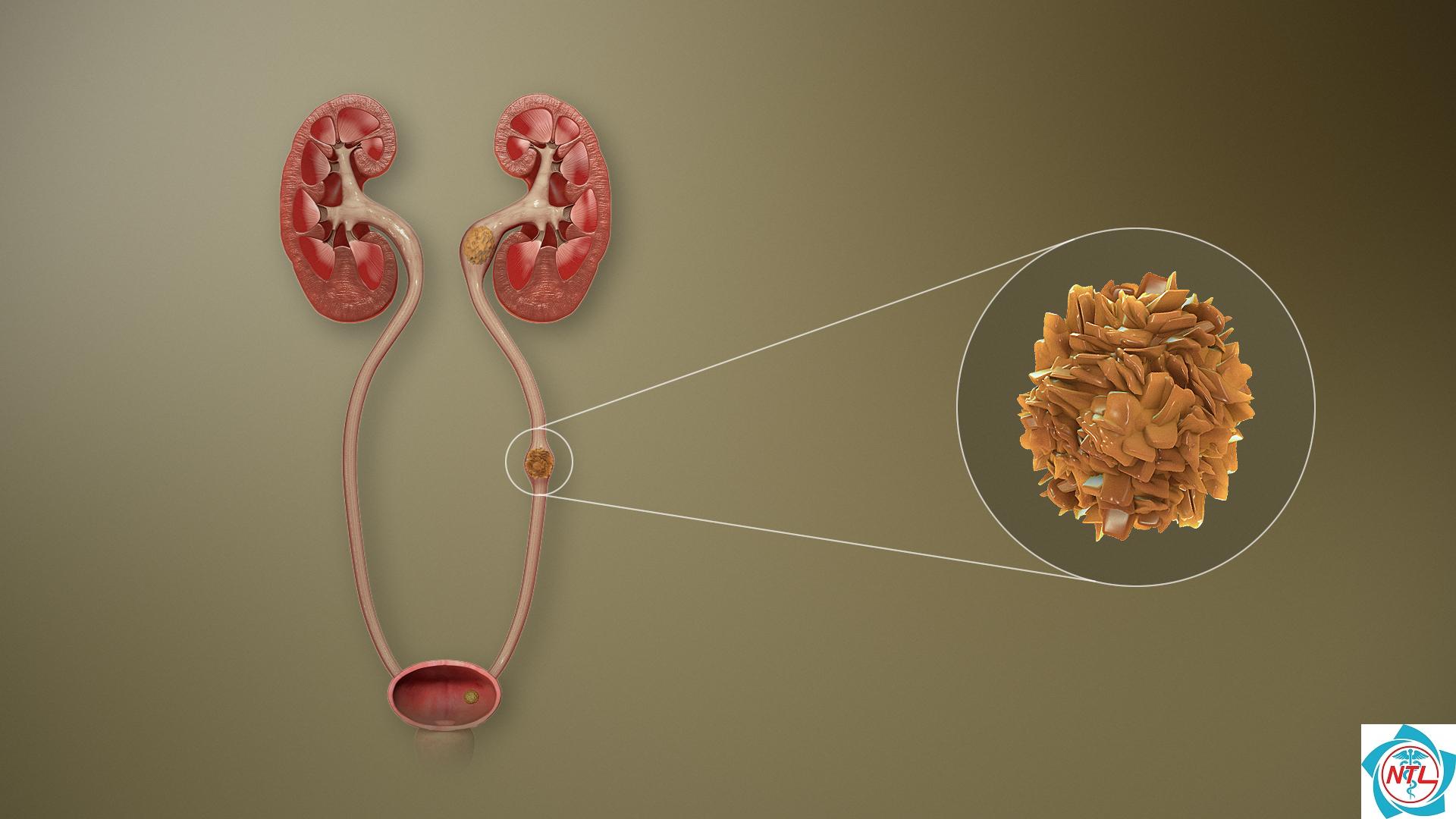 sỏi tiết niệu ở người cao tuổi - Image 3