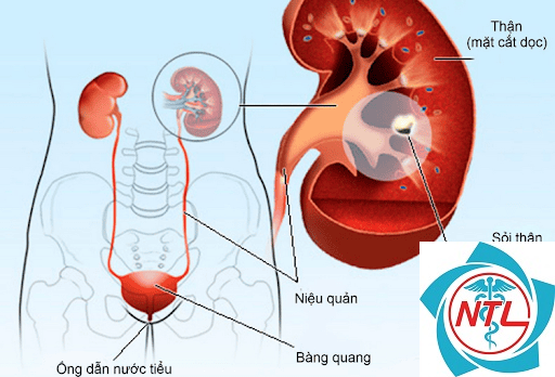 sỏi tiết niệu ở người cao tuổi - Image 4