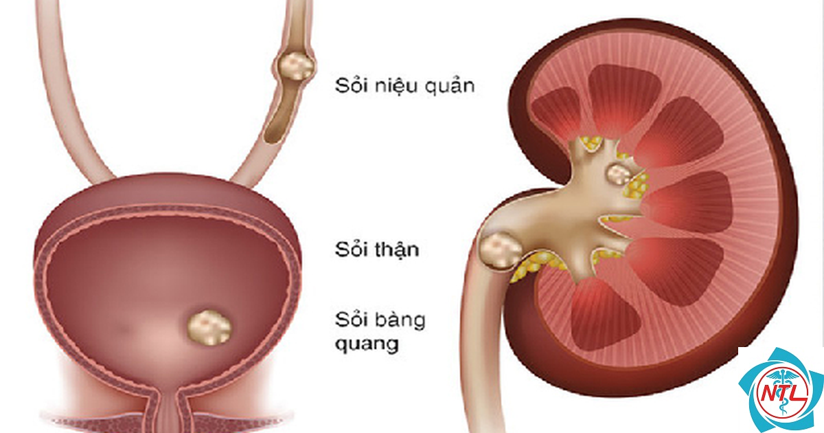 sỏi tiết niệu ở người cao tuổi - Image 1