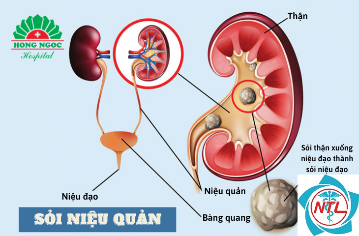 sỏi tiết niệu ở phụ nữ mang thai
