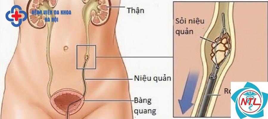 sỏi tiết niệu tái phát - Image 3