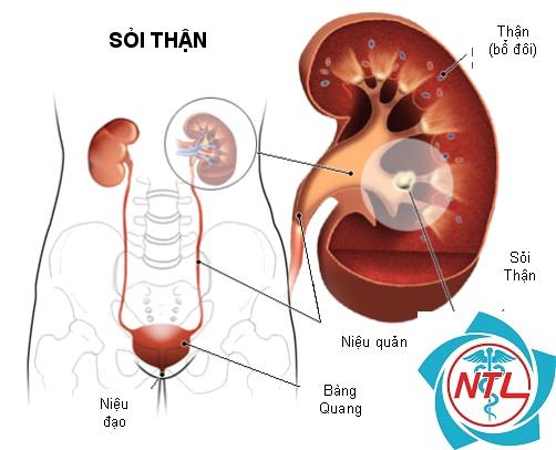 sỏi tiết niệu tái phát - Image 1