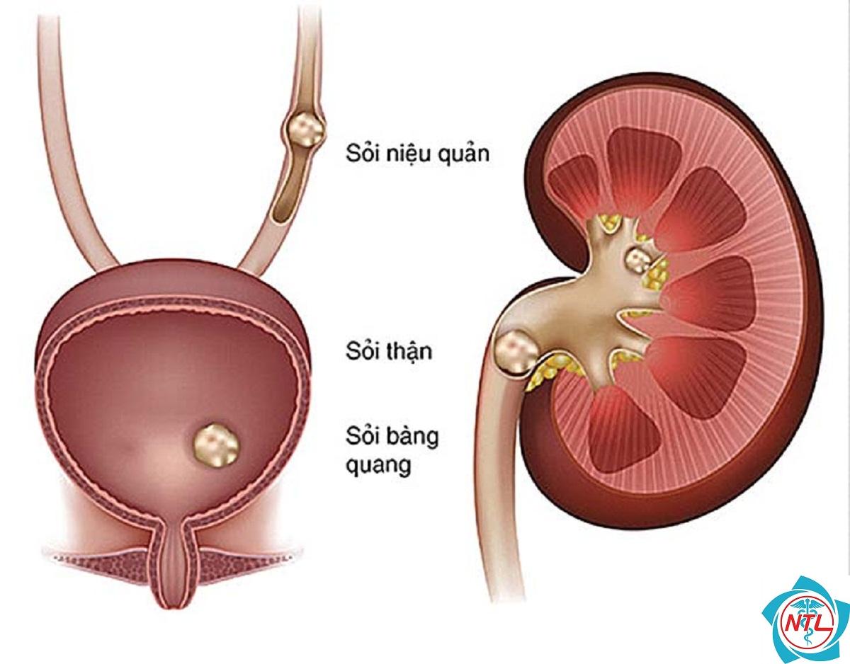 sỏi tiết niệu - Image 1