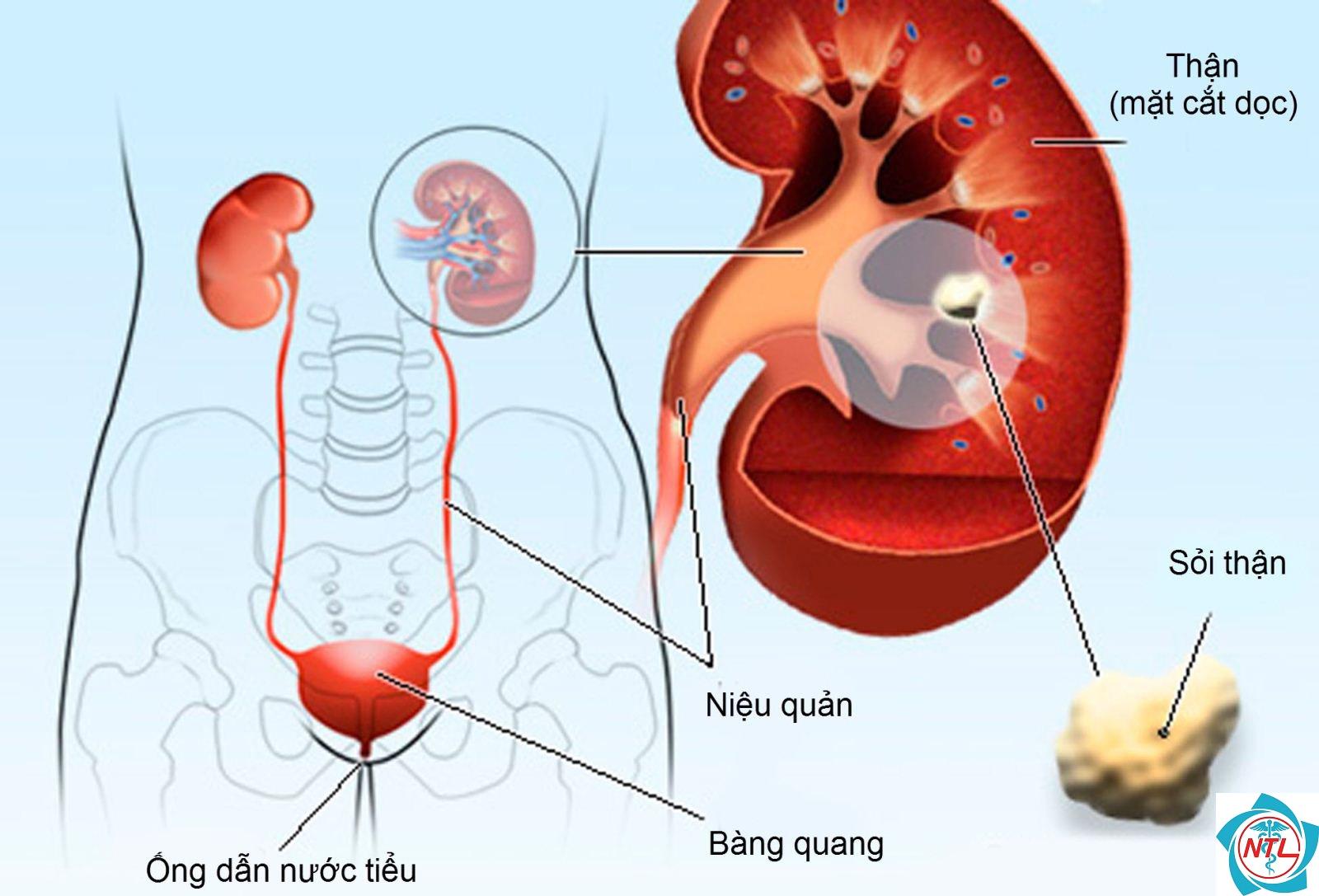 sỏi trong nang thận - Image 3