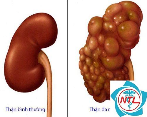 sỏi trong nang thận - Image 5