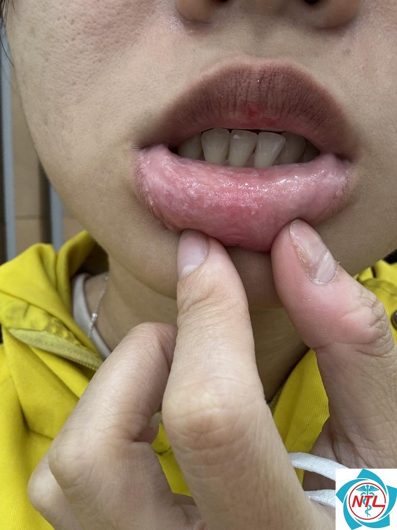 sùi mào gà - Image 3