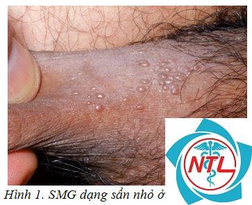 sùi mào gà ngoài da - Image 2