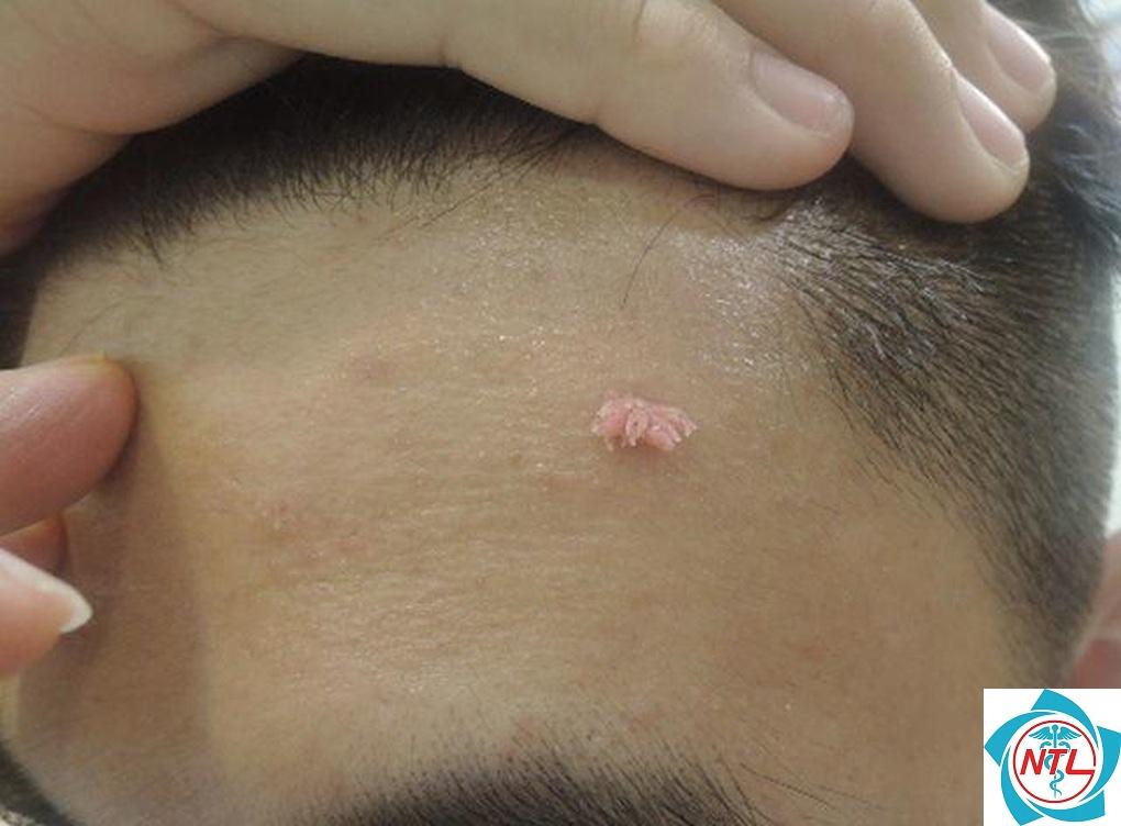sùi mào gà ngoài da - Image 3