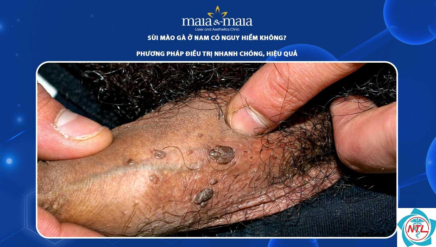 sùi mào gà ở nam giới - Image 2