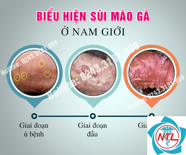 sùi mào gà ở nam giới - Image 3