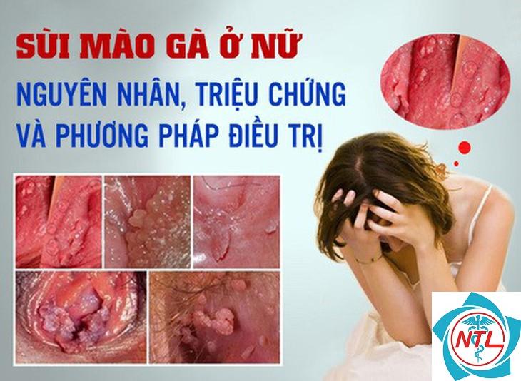 sùi mào gà ở nữ giới - Image 2
