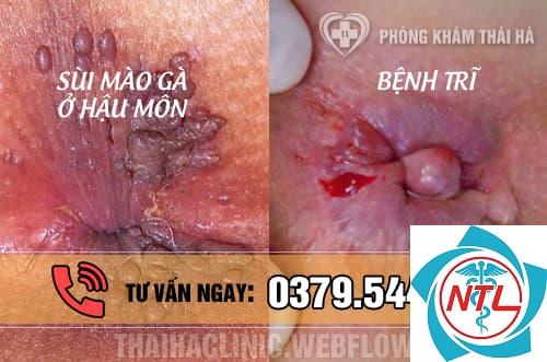 sùi mào gà quanh hậu môn - Image 2